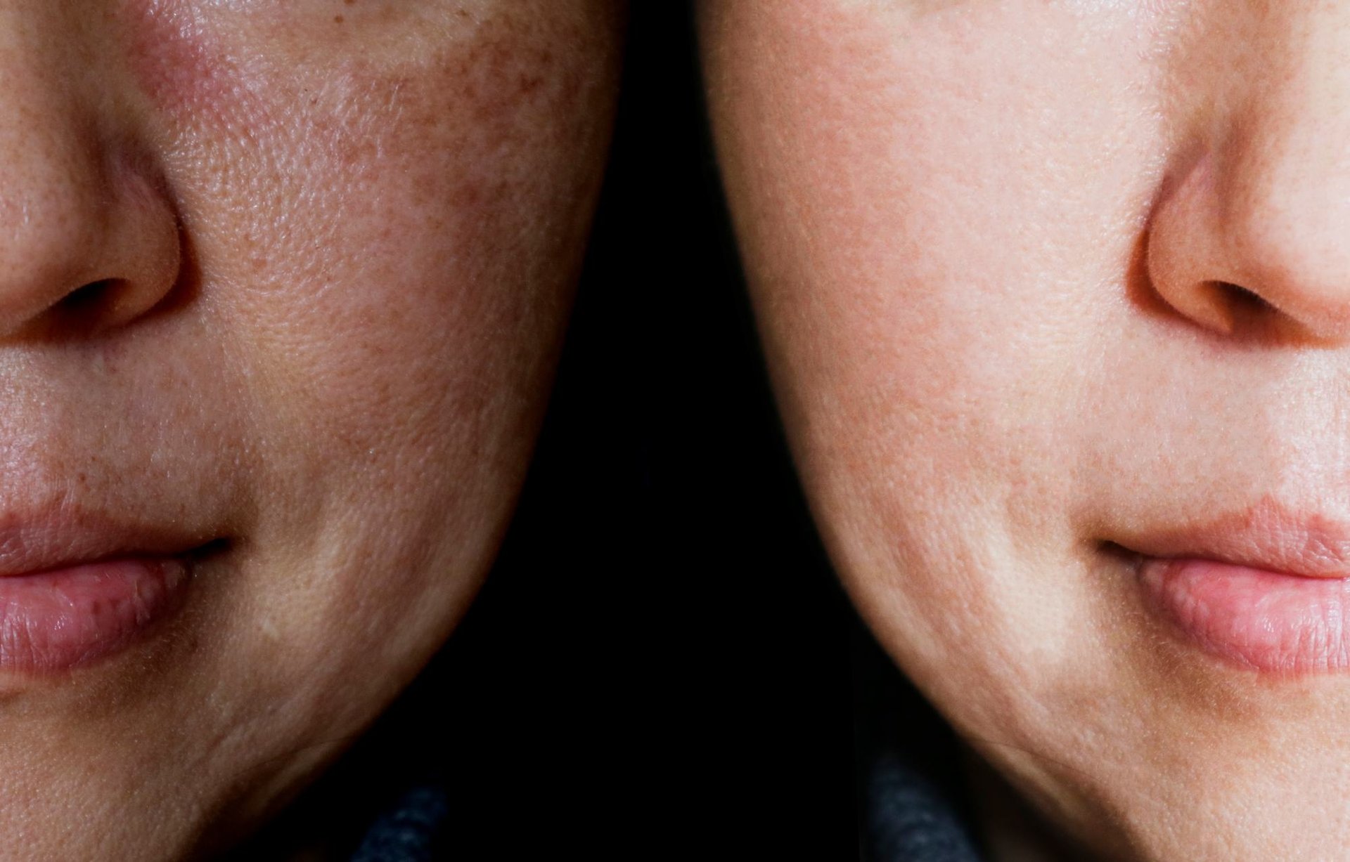 Nahaufnahme zweier Gesichtszustände: Eine mit auffälligen Poren und Melasma, die andere mit ebenmäßiger Haut